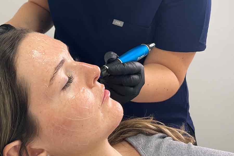 woman having a microneedle facial at the hidden retreat